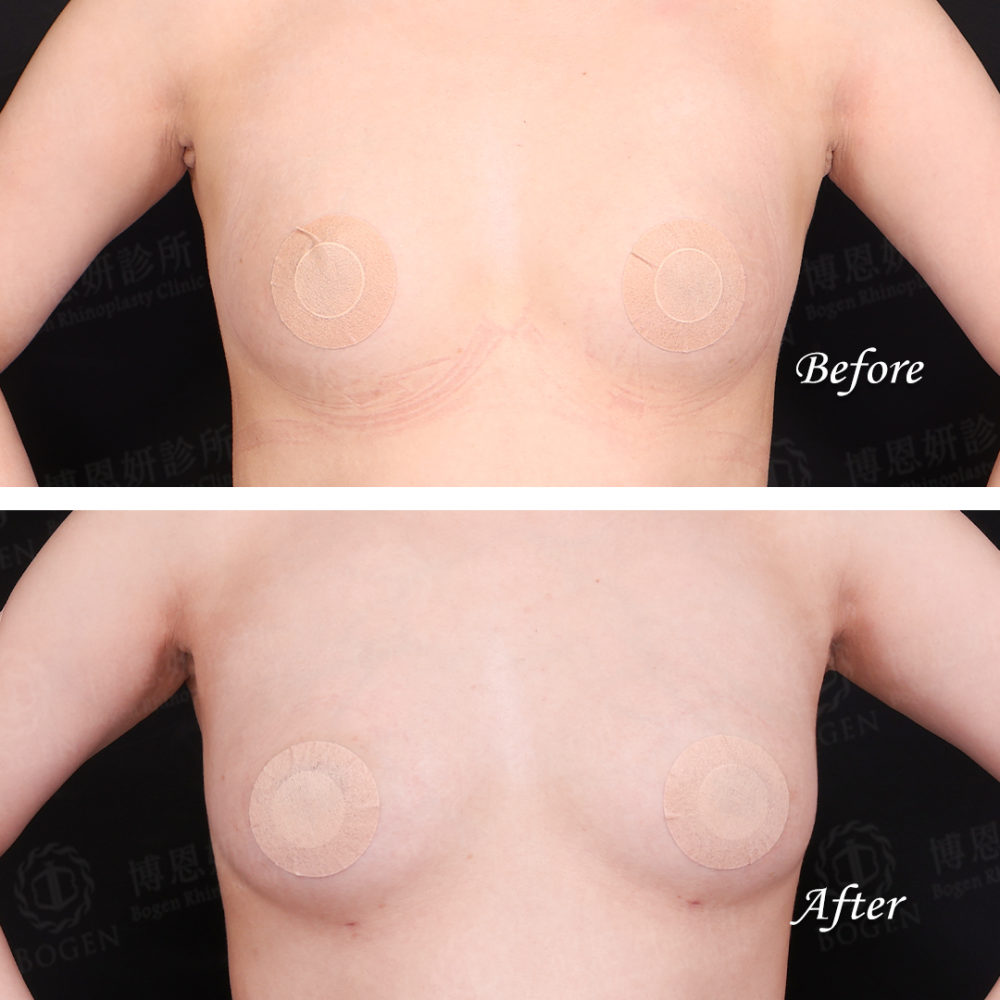 自體脂肪移植,自體脂肪移植胸部,自體脂肪移植隆乳,博恩妍